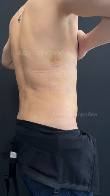 Мужская липосакция: результат на 9-й день
