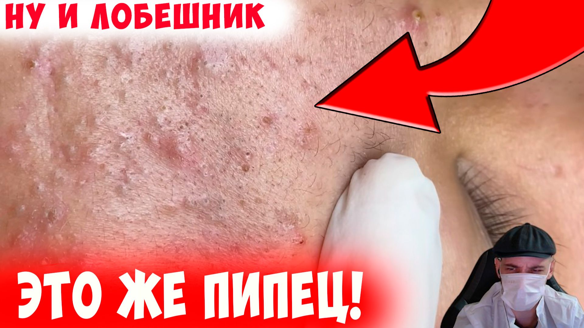 Неплохой Такой Лоб! Поможет ли Тут Чистка?