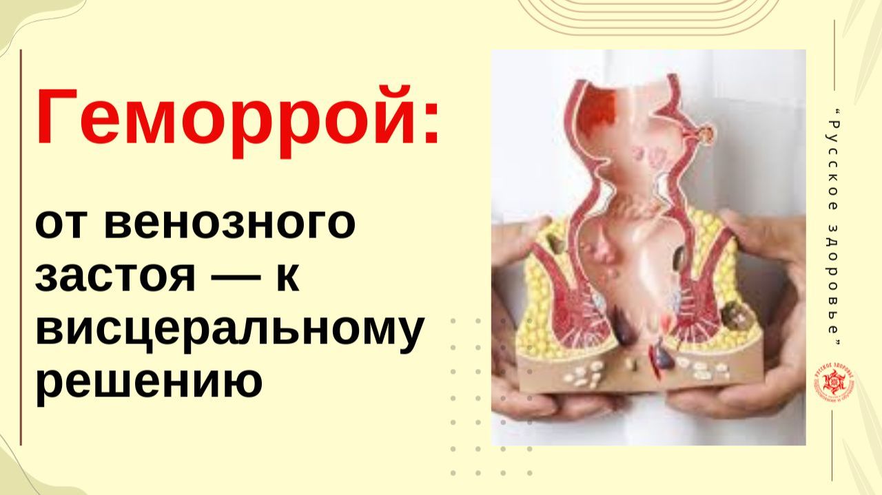 Геморрой: от венозного застоя — к висцеральному решению