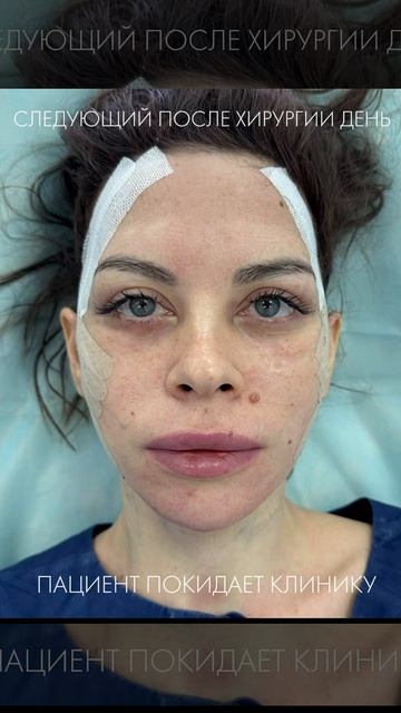 Deeplane Смаслифтинг