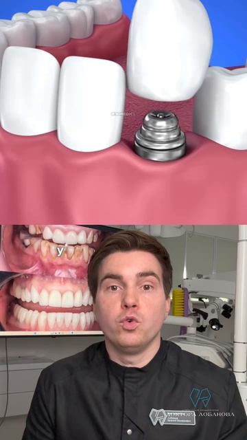 Раньше имплантация считалась премиум услугой, но сейчас это не так.