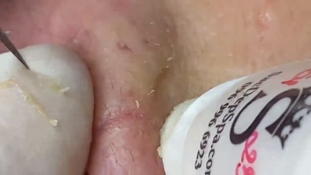 Выдавливание прыщей угрей черных точек и камедонов 384