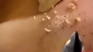 #287 Чистка лица от угрей и акне. Выдавливание прыщей. Удаление черных точек и комедонов