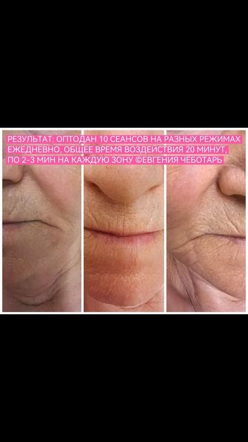 🌡КЕЙС: ГЕРПЕС, ЗАЕДЫ, ПРЫЩИ
🔥РЕЗУЛЬТАТ ПОСЛЕ 10 СЕАНСОВ НА АППАРАТЕ ОПТОДАН - ТЕРАПЕВТ СМ. ФОТО