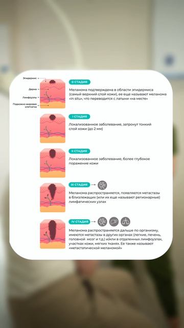 Как распознать меланому на раннем этапе 👇🏻