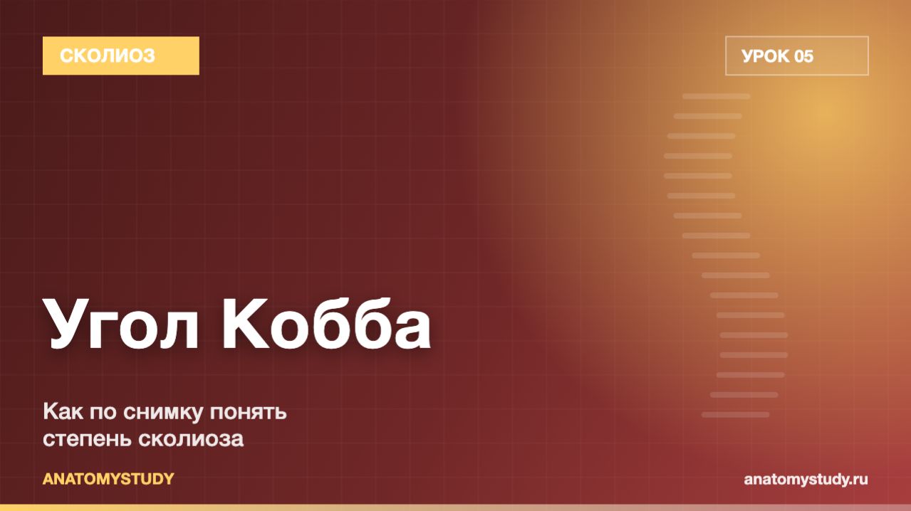 Угол Кобба: как по снимку понять степень сколиоза