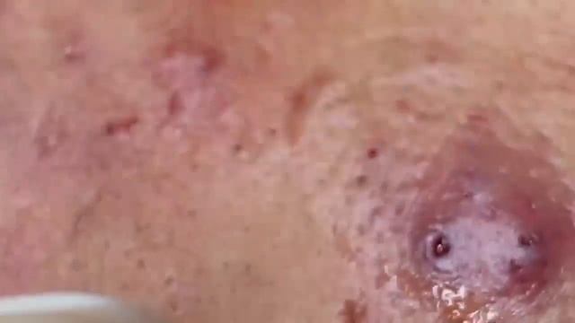 Выдавливание прыщей, угрей, черных точек и камедонов #388