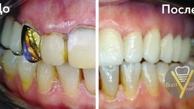 Верхняя челюсть / цельнокерамические коронки