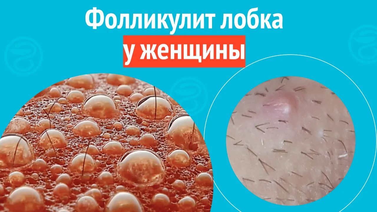 😐 Фолликулит лобка у женщины. Клинический случай № 1776