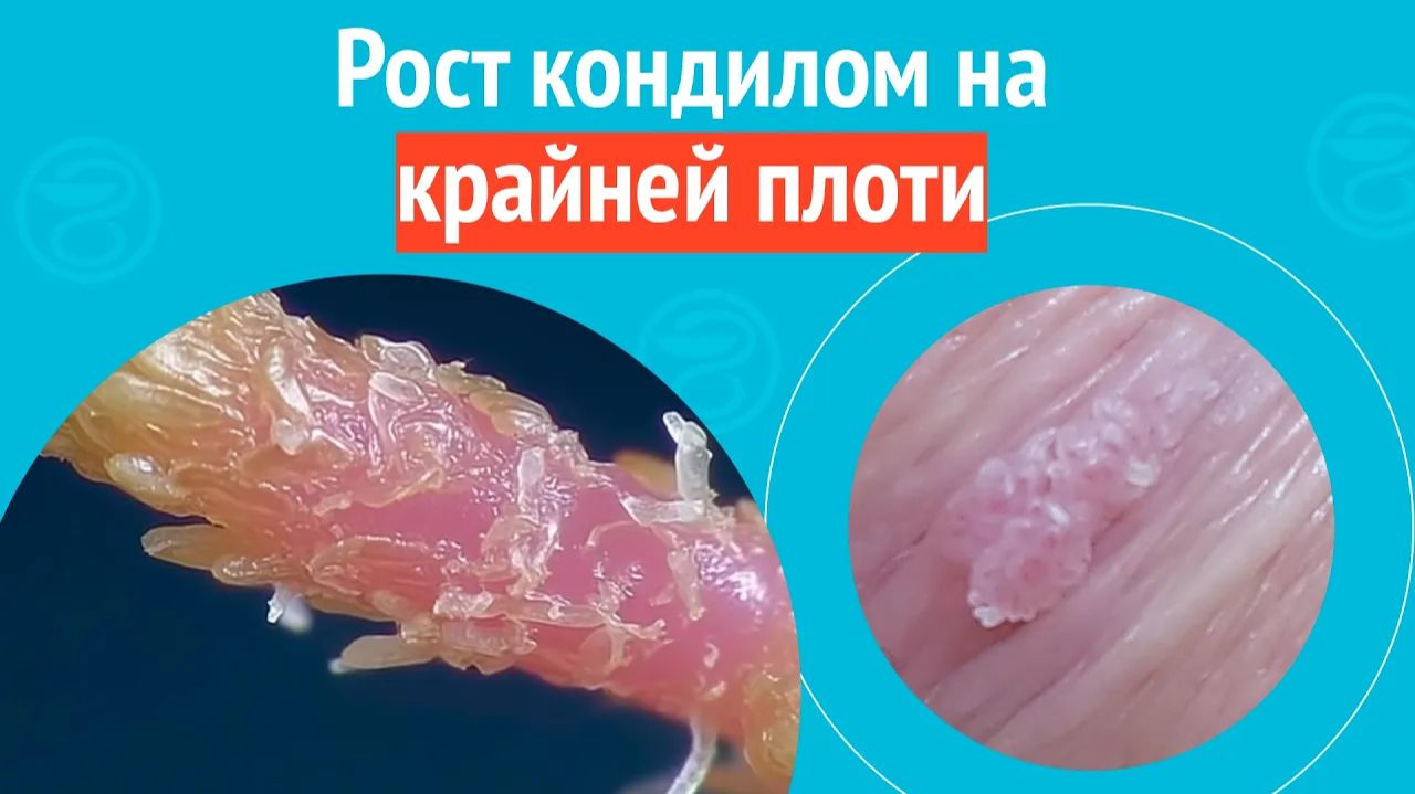 😮 Рост кондилом на крайней плоти. Клинический случай № 1777
