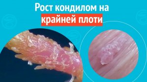 😮 Рост кондилом на крайней плоти. Клинический случай № 1777