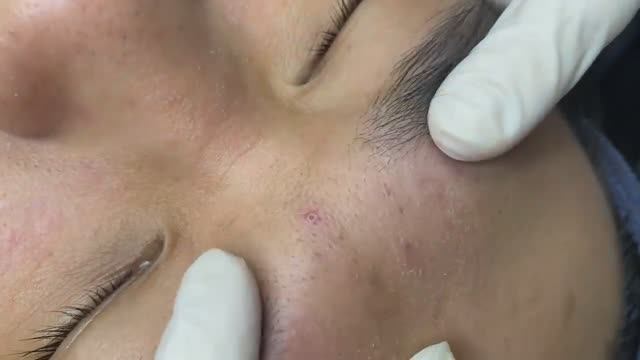 098 • Acne Collection • АСМР • Relax Spa
