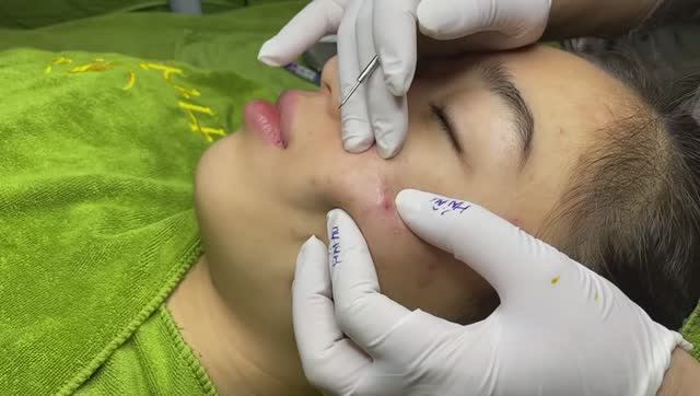 Чистка лица от забитых прыщами пор