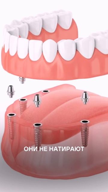 Преимущества имплантации перед протезированием