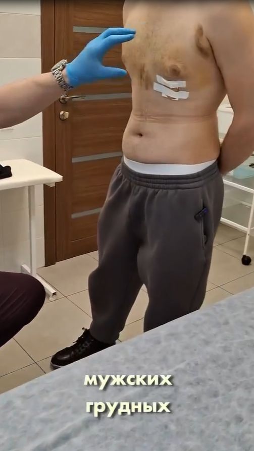 Уменьшение груди у мужчины - 7 дней после операции!