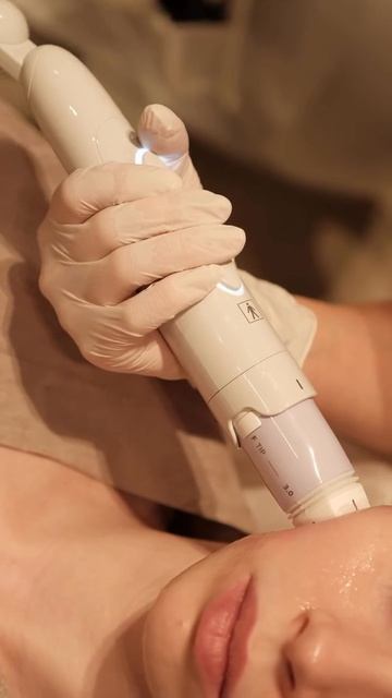 SMAS-лифтинг Ultraformer