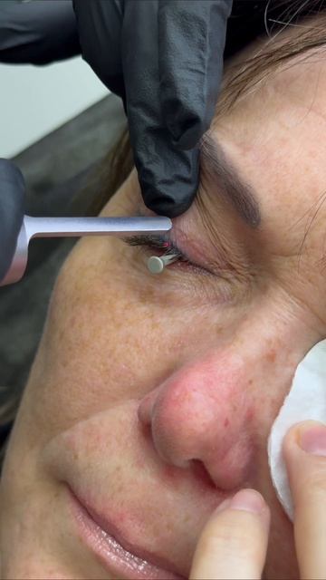 Для тех кто ни разу не видел как происходит процедура удаления татуажа век с обязательной установк