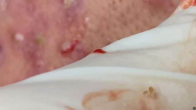 Тяжеленный Случай Акне - Тут нужна Серьезная Помощь