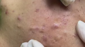 Удаление акне у пациента. Часть 1