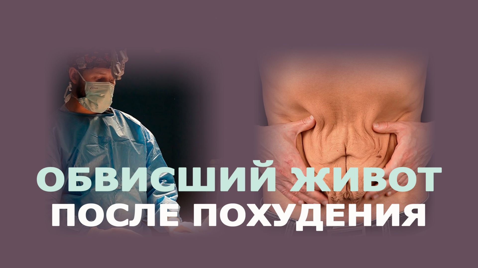 Абдоминопластика у мужчины: результат сразу после и через 4 месяца