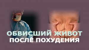 Абдоминопластика у мужчины: результат сразу после и через 4 месяца