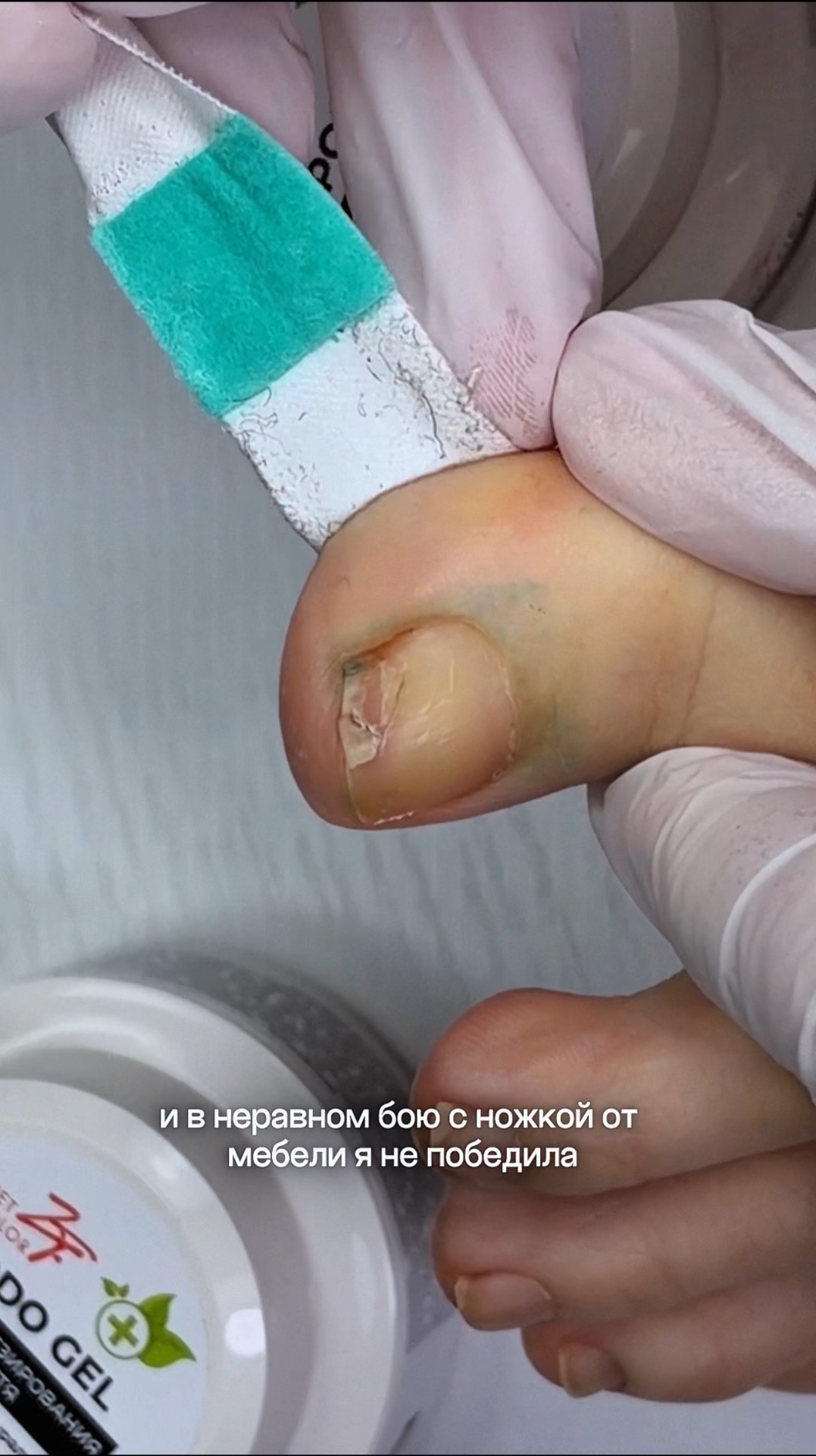 сломала СВОЙ ноготь о тумбу  сделала протезирование чтобы не было так больно 
