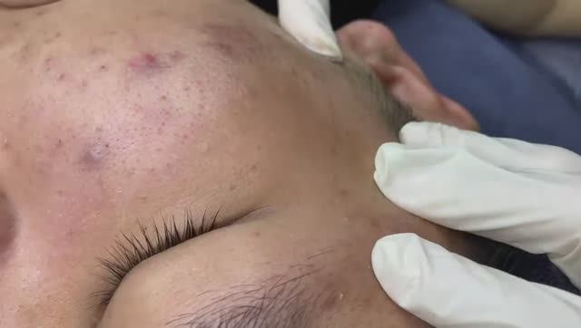 099  Acne collection  АСМР  Relax Spa