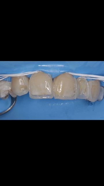 Результаты реставрации зубов: до и после