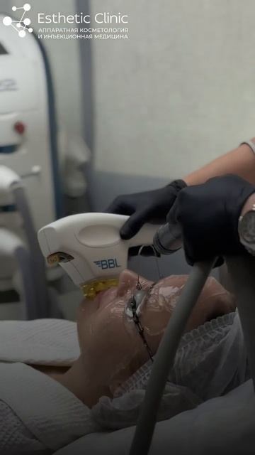 Фототерапия на аппарате BBL