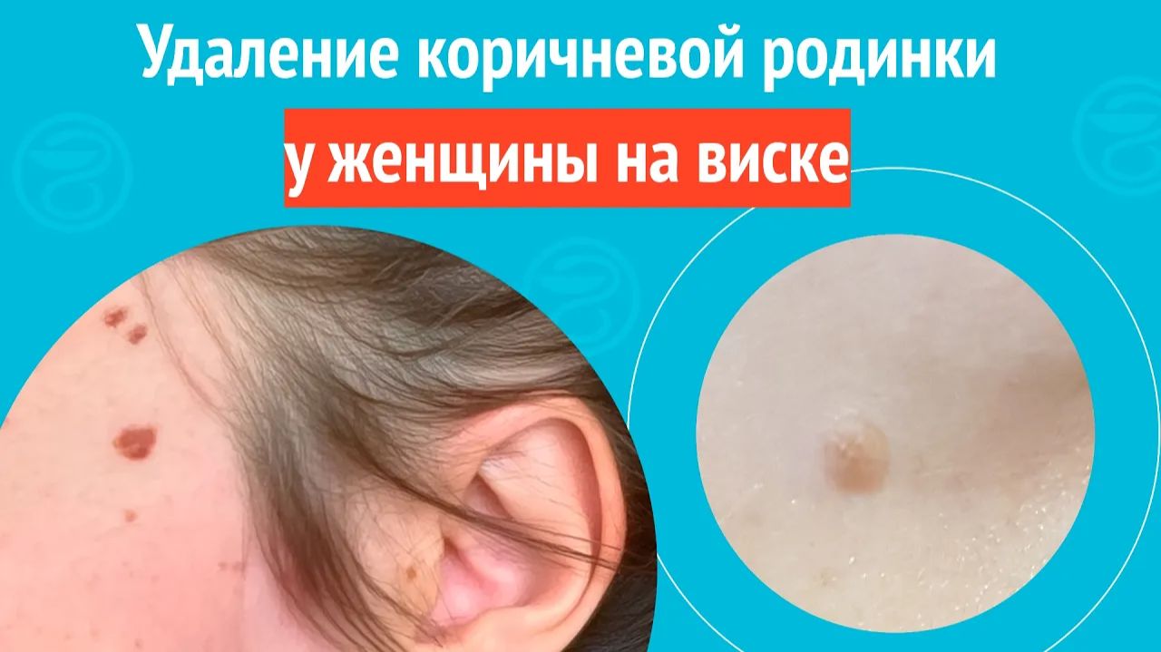 ✅ Удаление коричневой родинки у женщины на виске. Клинический случай № 1775