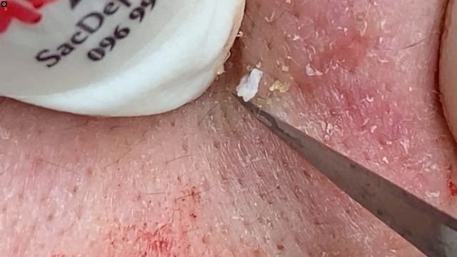 Очень Активная и Обширная Чистка Лица от Комедонов и Пустул