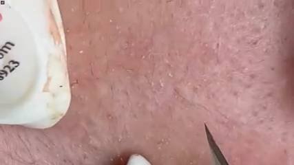 Еше Один Довольно Сложный Клиент у Мастера по Очистке Лица