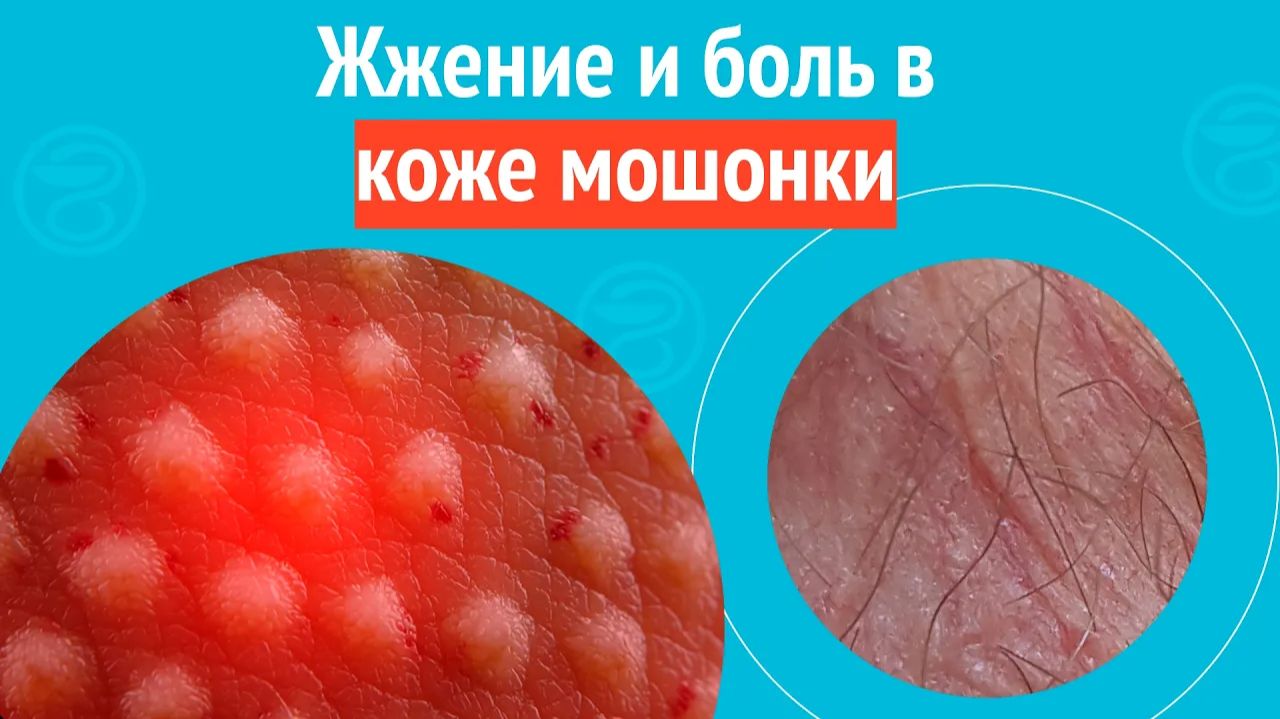  Жжение и боль в коже мошонки. Клинический случай  1771