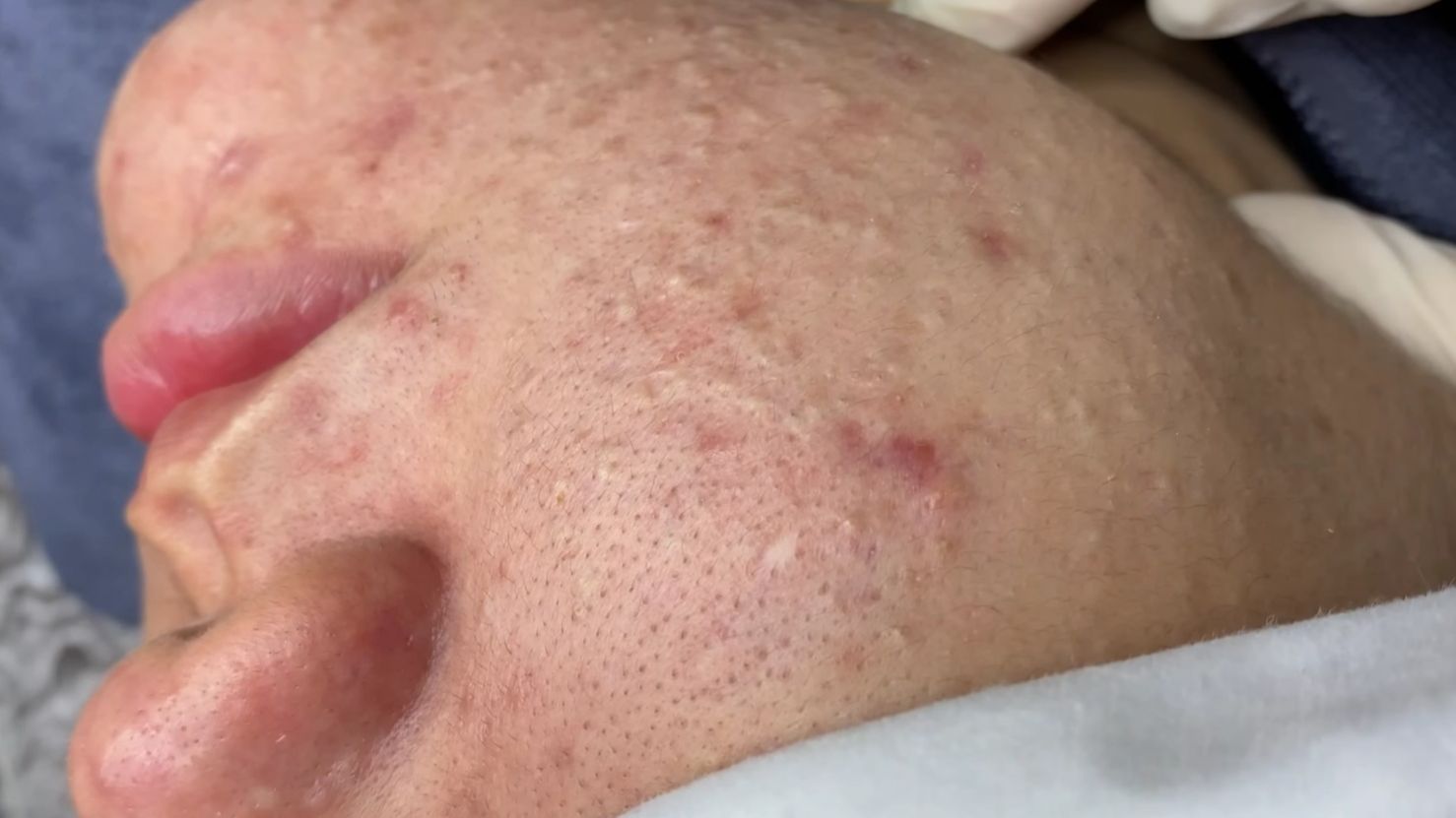 Сальные железы работают очень активно - Мастеру давить и давить