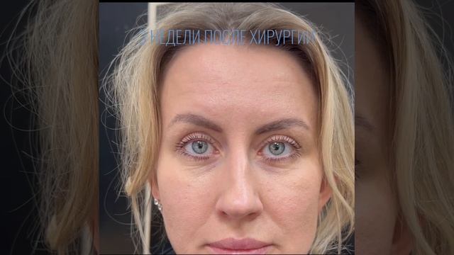 3 недели после операции верхняя блефаропластика