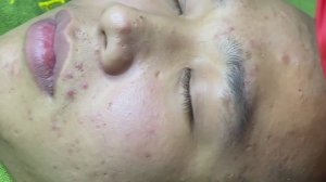 Удаление акне у пациента. Часть 2