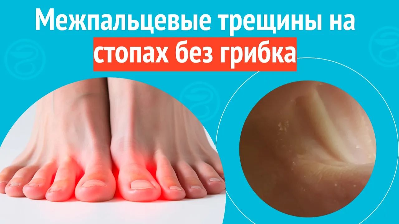 🦶 Межпальцевые трещины на стопах без грибка. Клинический случай № 1772