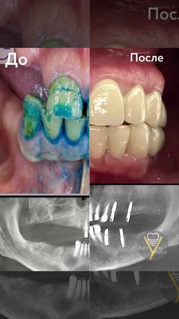 Металлокерамика на имплантатах