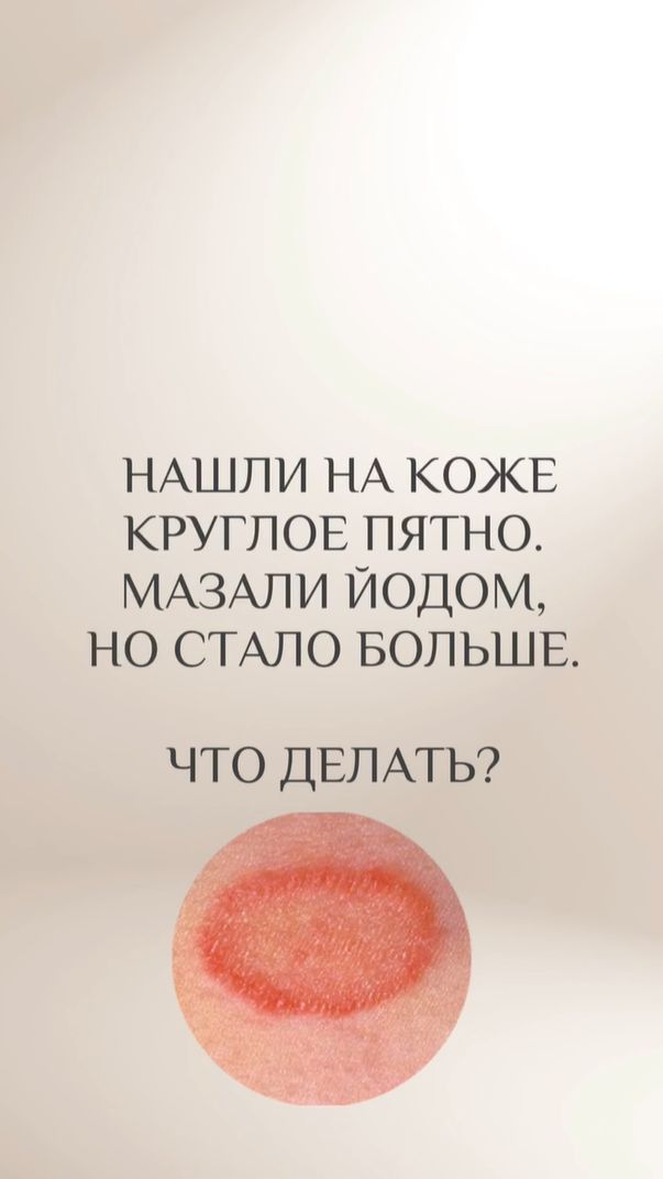 Нашли у ребёнка «круг» на коже? Только не делайте ЭТО! Действия 90% родителей усугубляют проблему
