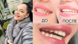 Я СНЯЛА БРЕКЕТЫ | что дальше и мои рекомендации