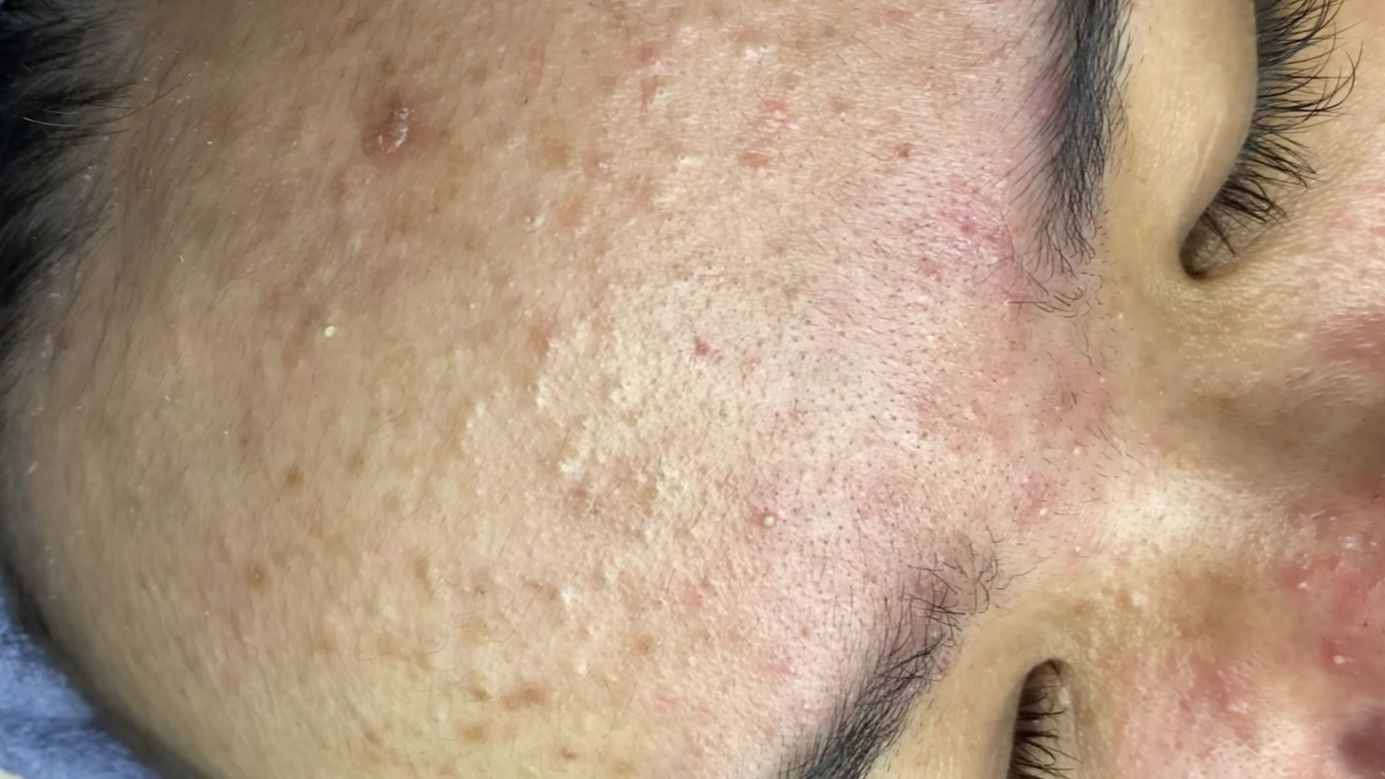 Длительное Выдавливание Прыщей у Девушки