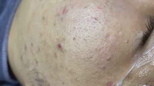 100  Acne collection  АСМР  Relax Spa
