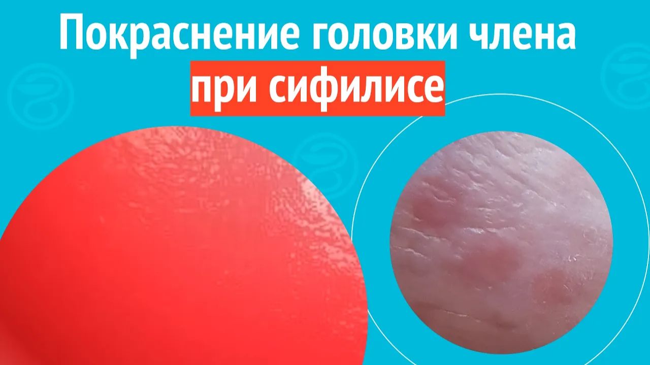 🥵 Покраснение головки члена при сифилисе. Клинический случай № 1773
