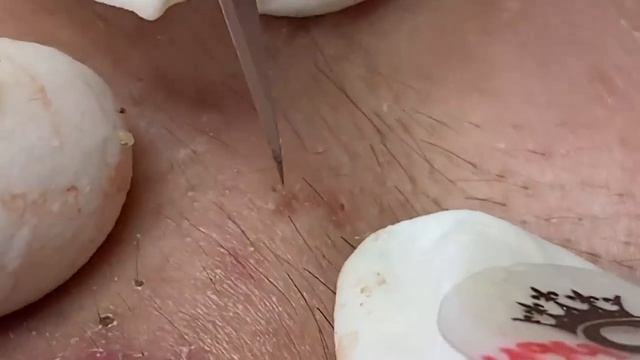 Выдавливание прыщей, угрей, черных точек и камедонов #387