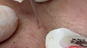 Выдавливание прыщей, угрей, черных точек и камедонов #387