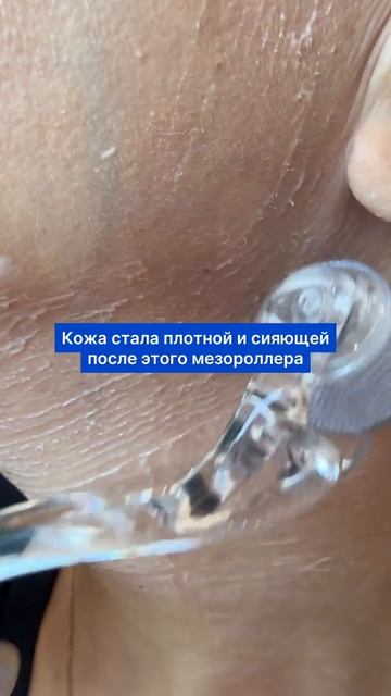 Безболезненная замена мезотерапии 