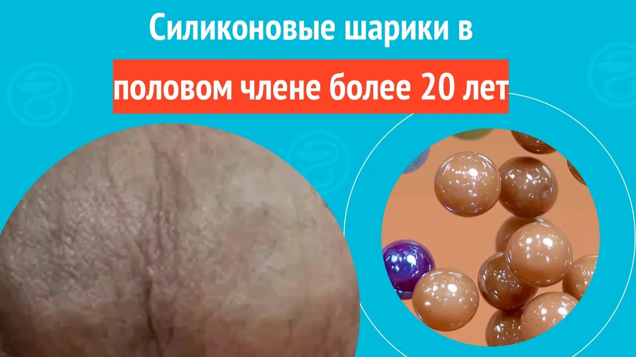 🥎 Силиконовые шарики в половом члене более 20 лет. Клинический случай № 1770
