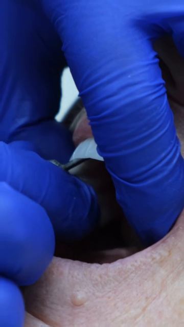 имплантация