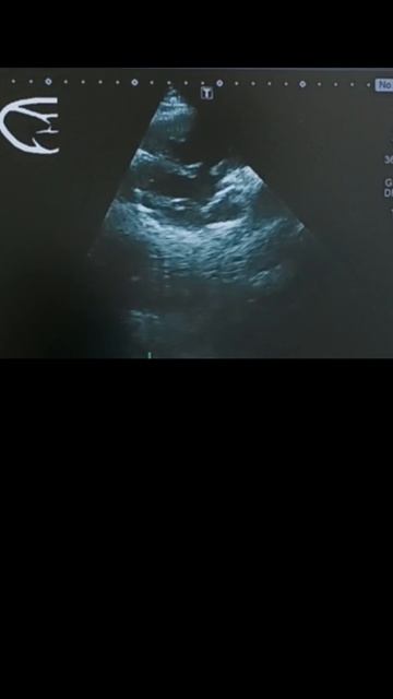 #дефект МЖП