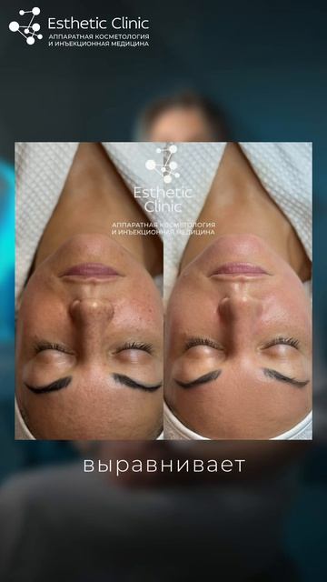 Почему после обычной чистки все возвращается? А с пилингом —нет